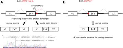 Functional and clinical analysis of five EDA variants associated with ectodermal dysplasia but with a hard-to-predict significance